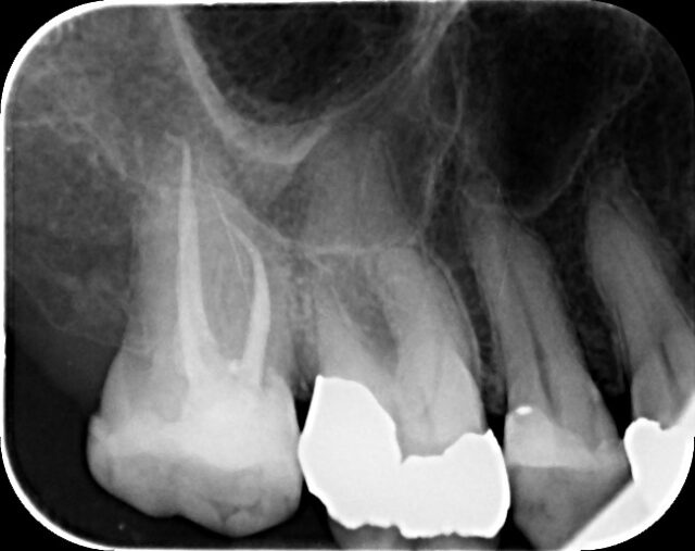 An x-ray shows two teeth, one with the root intact and the other with the canal cleaned and filled.